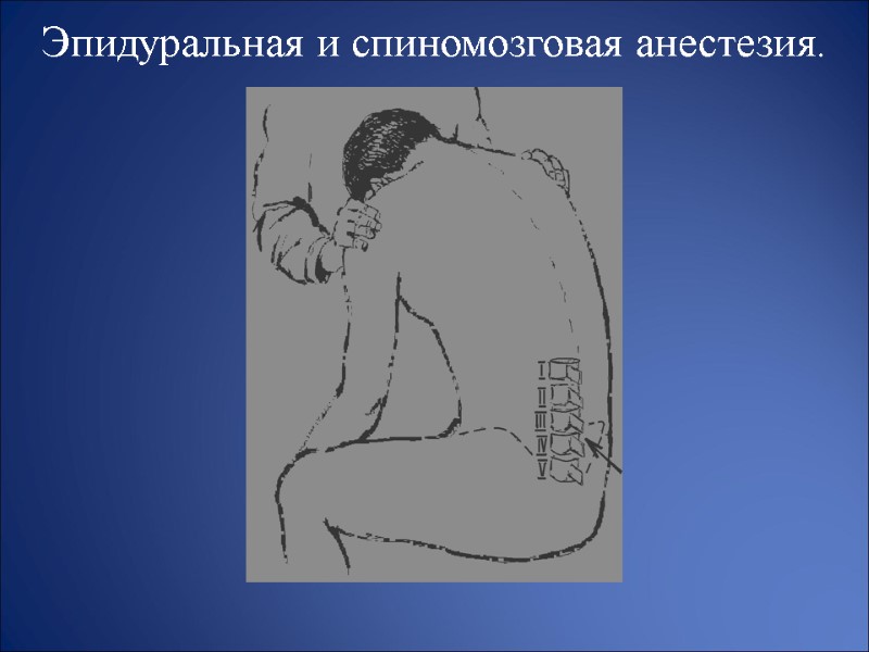 Эпидуральная и спиномозговая анестезия.